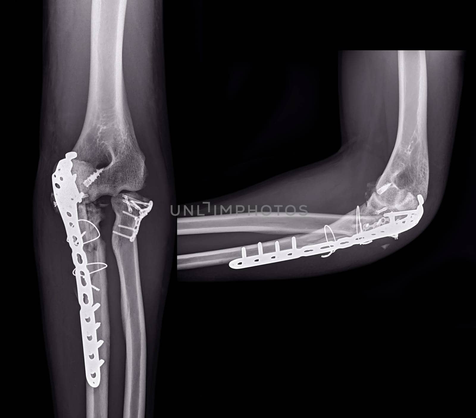 X-ray of Elbow showing internal fixation of the elbow joint. by samunella