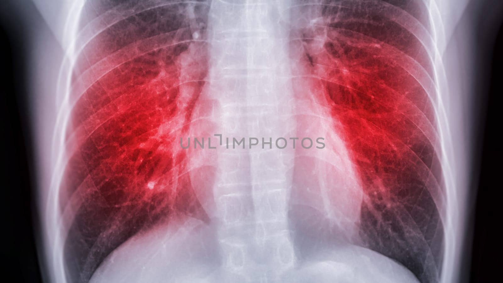 Chest x-ray image for screening diagnosis TB,tuberculosis and covid-19.