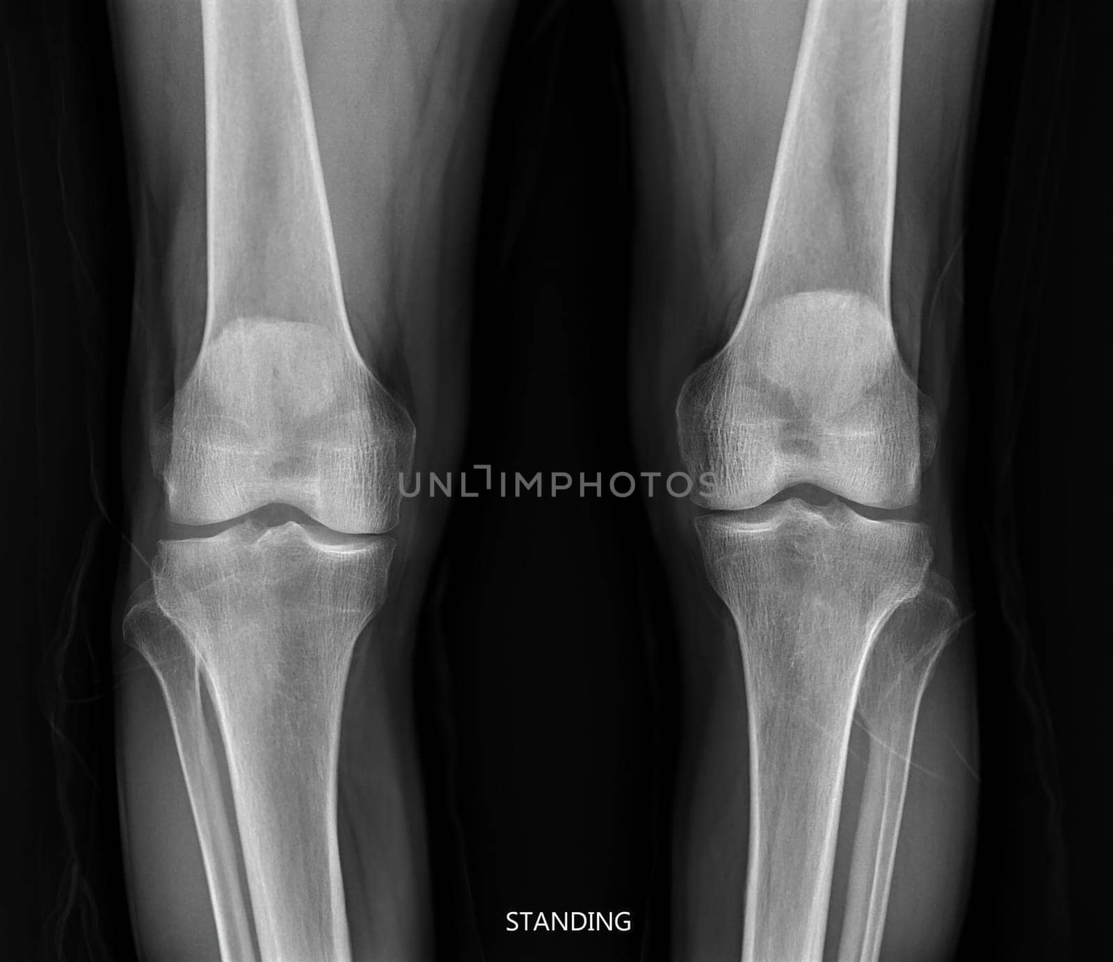 film x-ray both knee joint AP view for diagnosis knee pain from osteoarthritis knee and fracture . by samunella