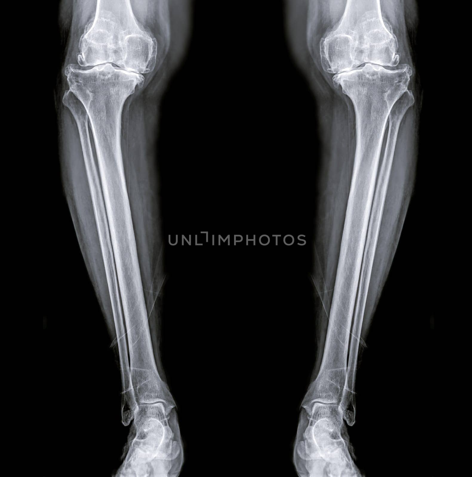 film x-ray both Leg AP view for diagnosis knee pain from osteoarthritis knee and fracture .