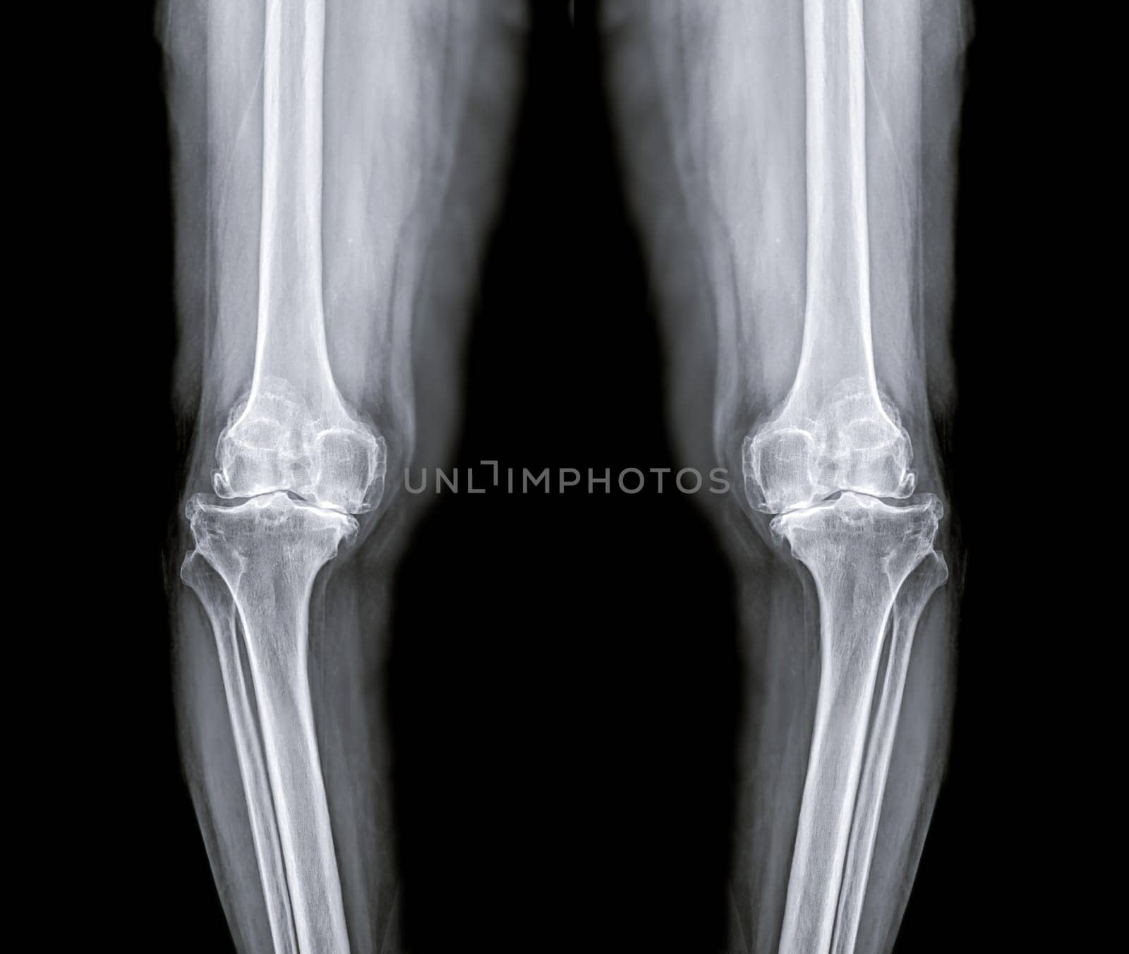 film x-ray both knee joint AP view for diagnosis knee pain from osteoarthritis knee and fracture .