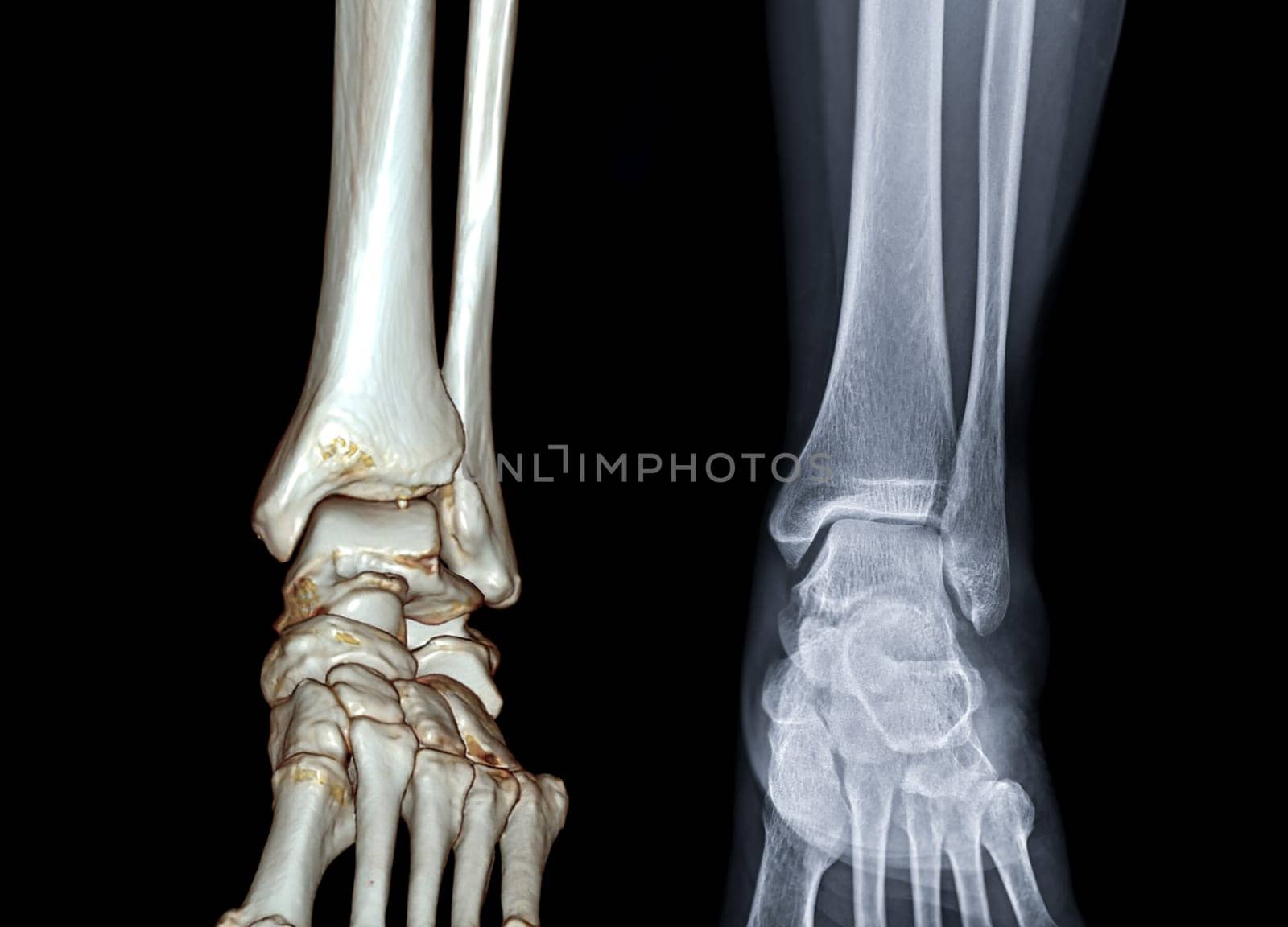 X-ray of knee joint and CT knee 3D rendering .