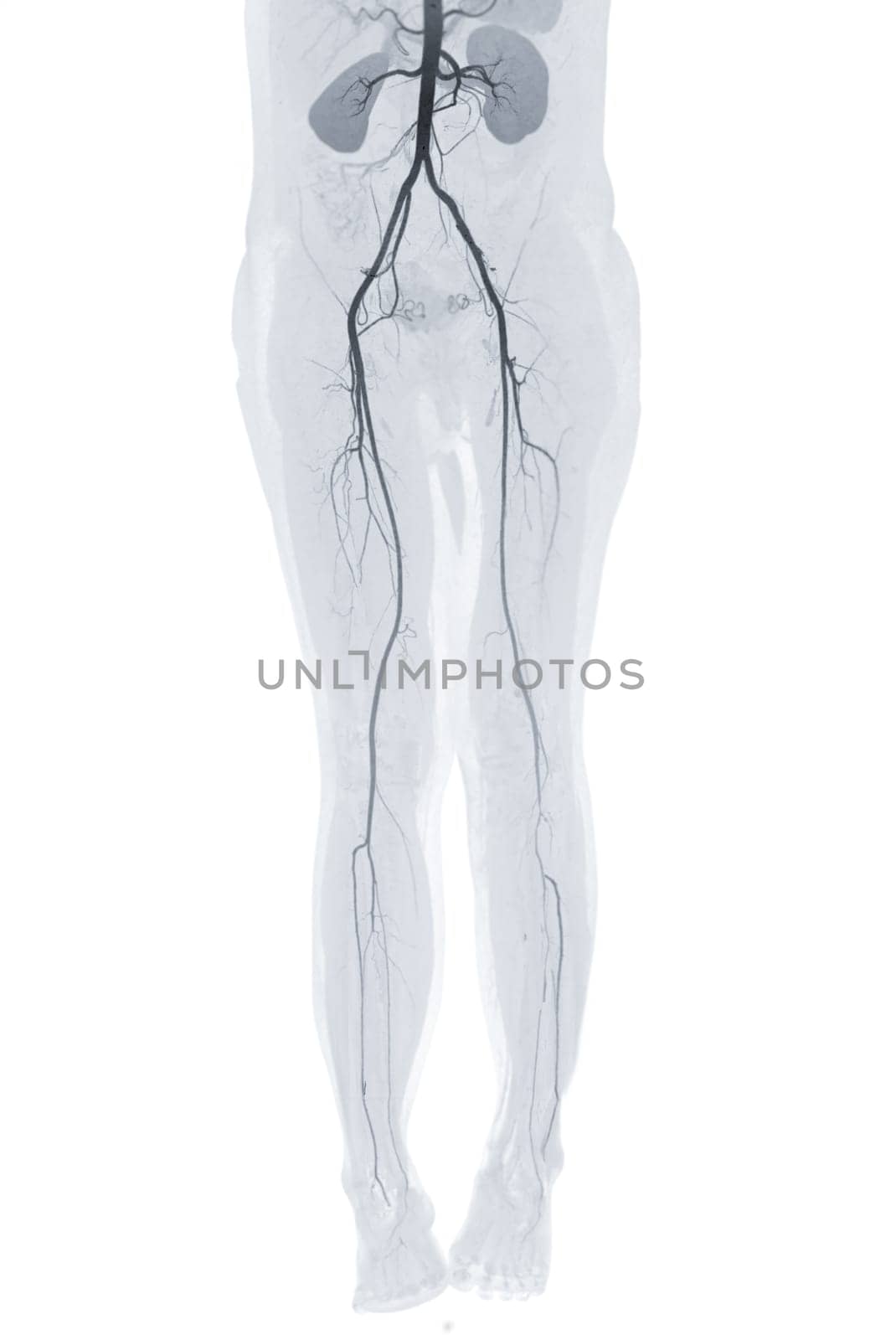 CTA femoral artery run off showing femoral artery Presenting with Acute or Chronic Peripheral Arterial Disease.