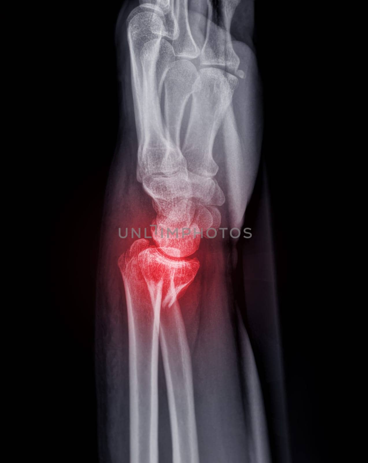 X-ray image of Left wrist joint AP and Lateral view for showing fracture of radius bone.