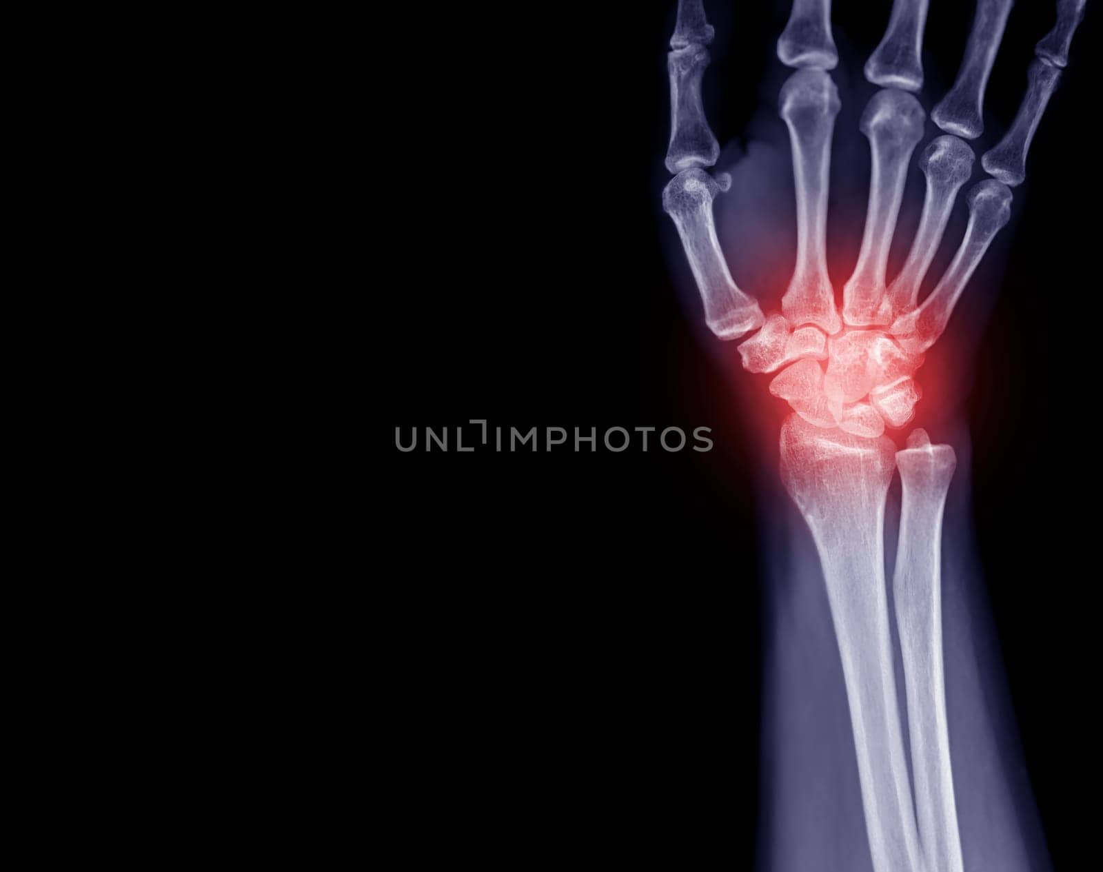 X-ray image of wrist joint front view of normal wrist joint. by samunella