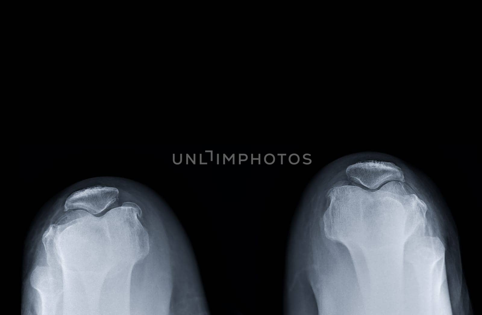 X-ray image of both Normal patella . by samunella