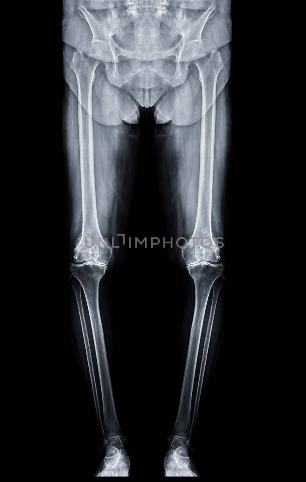 Scanogram is a Full-length standing AP radiograph of both lower extremities including the hip, knee, and ankle.