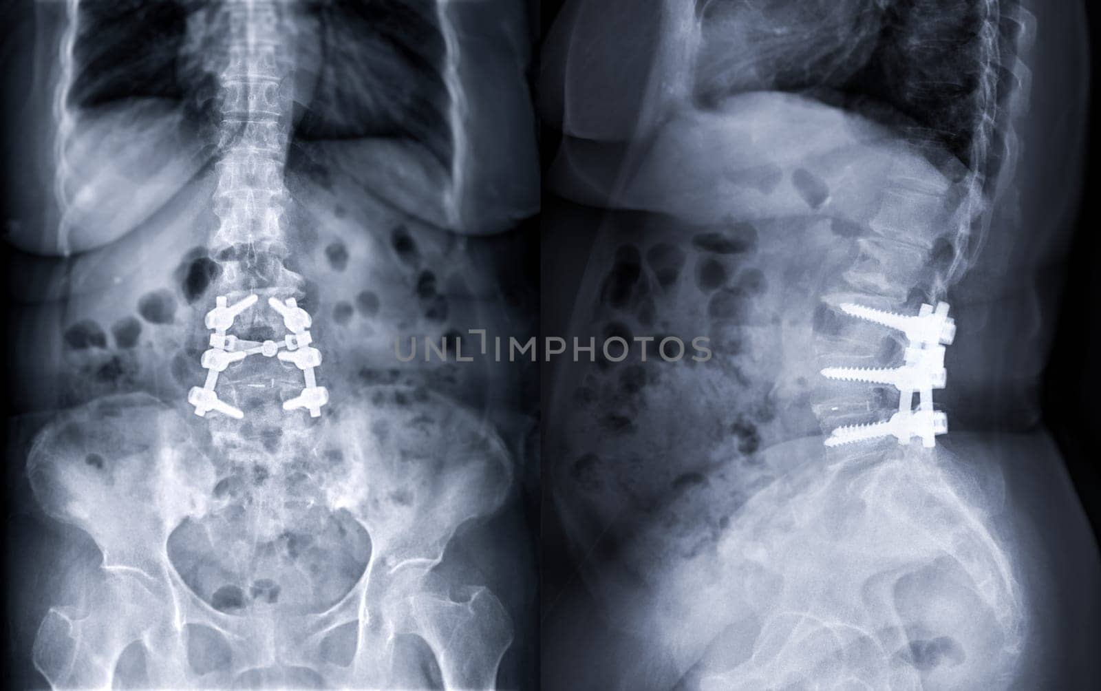 X-ray image of Lumbar spine showing pedicle screw fixation and decompression surgery in patient with spinal canal stenosis. by samunella