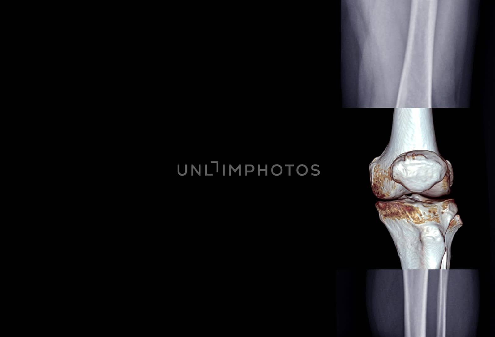 Film x-ray of knee joint AP view fusion with 3D rendering knee joint for medical background.