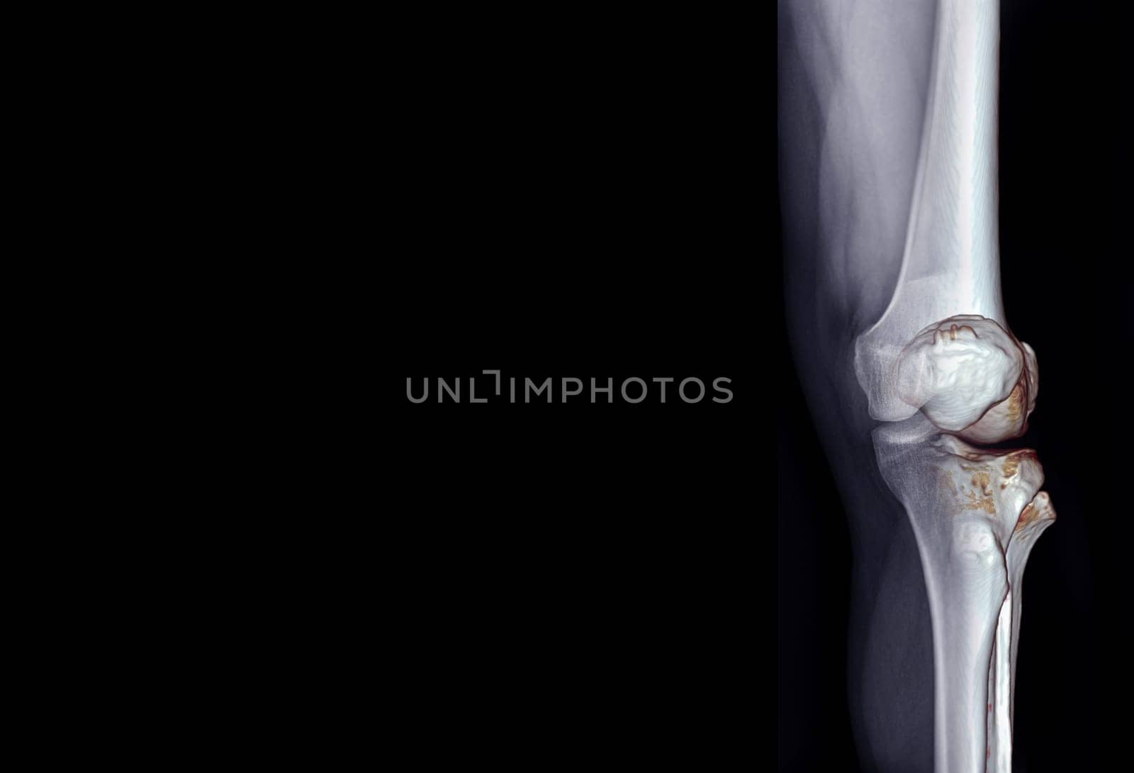 Film x-ray of knee joint AP view fusion with 3D rendering knee joint for medical background.