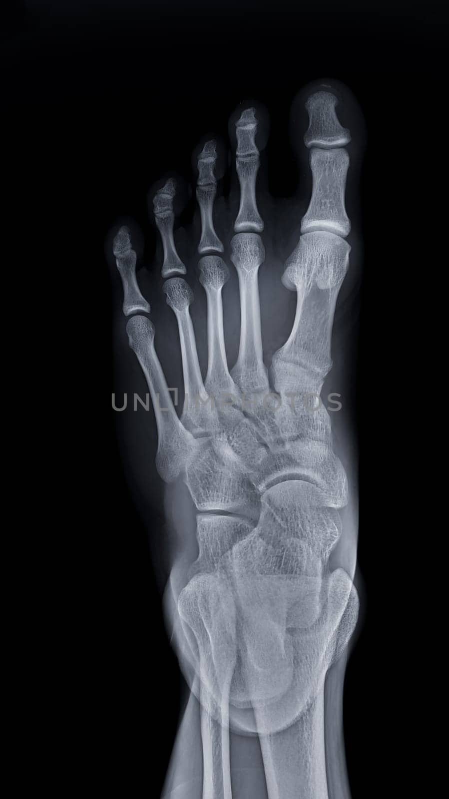 Foot x-ray image AP view isolated on black background.