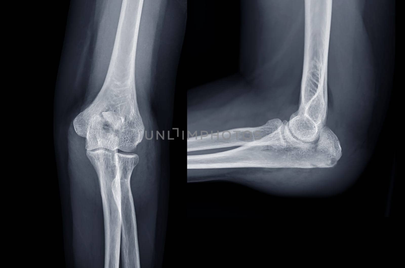 X-ray of Elbow join showing fracture of ulna bone.