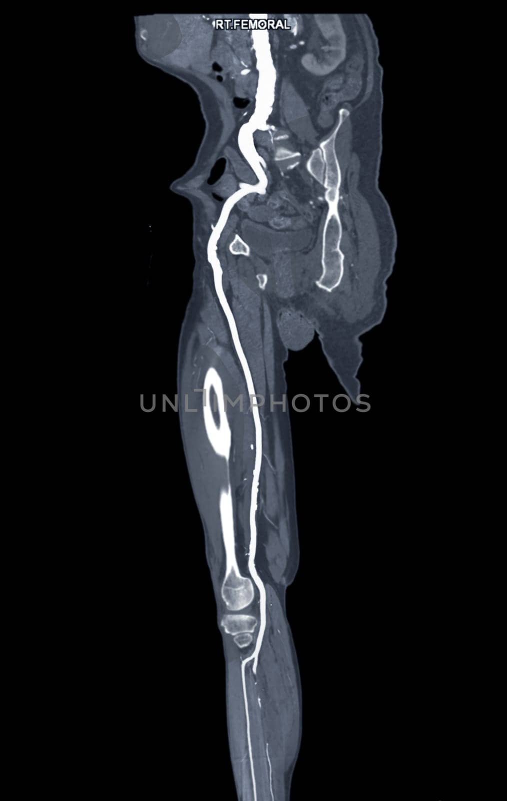 CTA femoral artery run off MPR curve showing Right femoral artery for diagnostic Acute or Chronic Peripheral Arterial Disease.