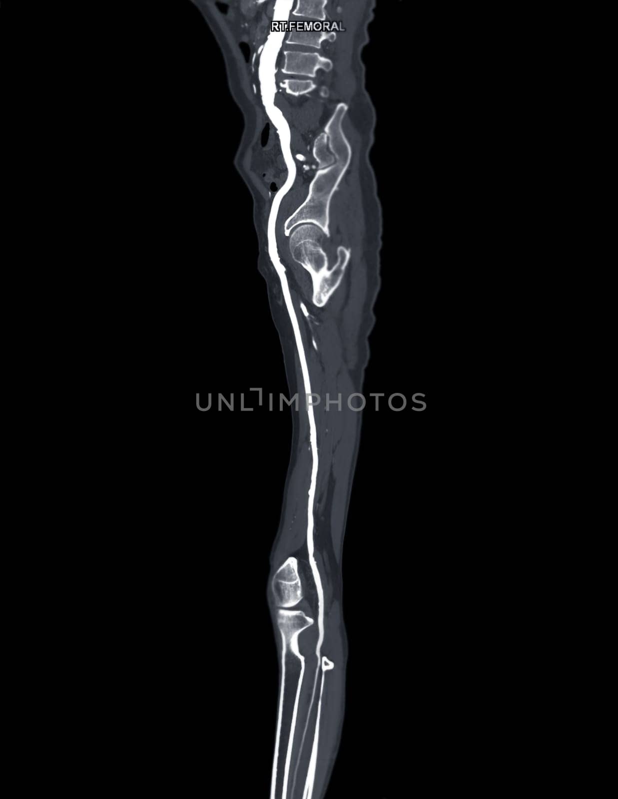 CTA femoral artery run off MPR curve showing Left femoral artery for diagnostic Acute or Chronic Peripheral Arterial Disease.