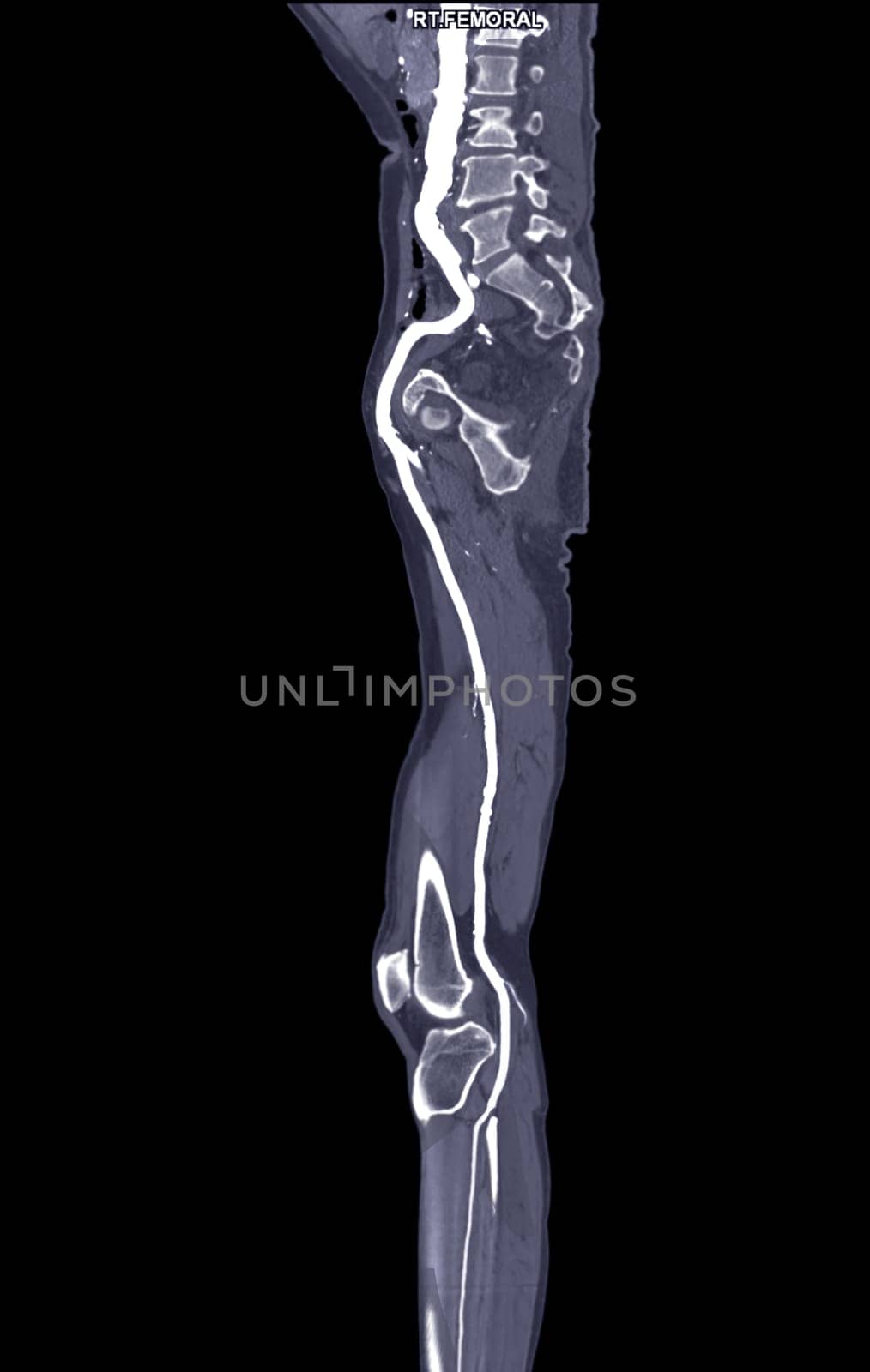 CTA femoral artery run off MPR curve showing Right femoral artery for diagnostic Acute or Chronic Peripheral Arterial Disease.