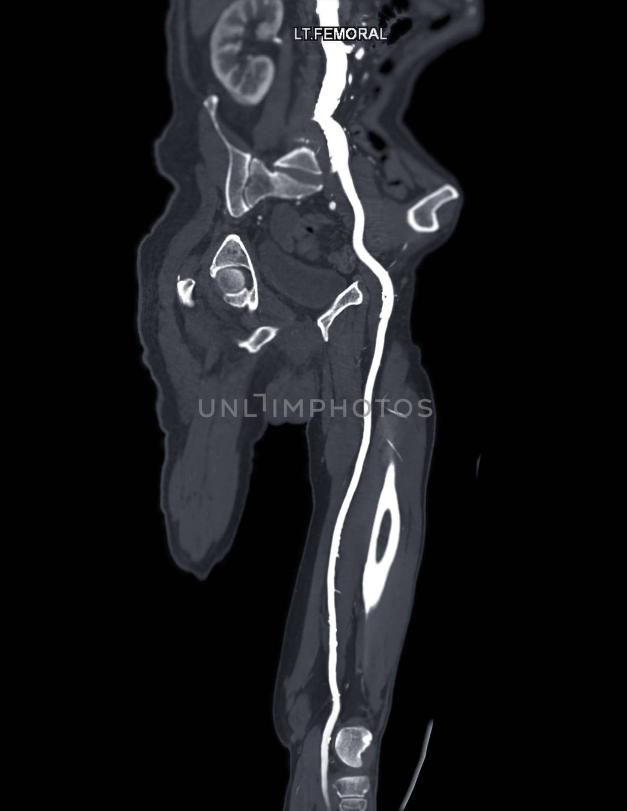 CTA femoral artery run off MPR curve showing Left femoral artery for diagnostic Acute or Chronic Peripheral Arterial Disease.