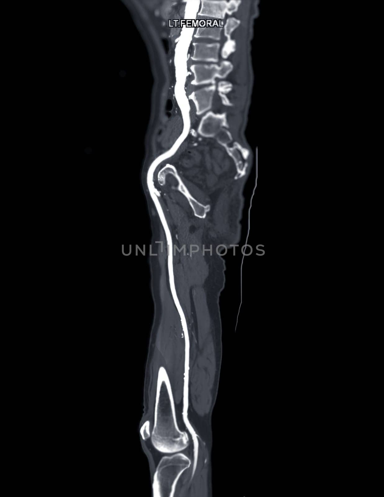 CTA femoral artery run off MPR curve showing Left femoral artery for diagnostic Acute or Chronic Peripheral Arterial Disease.