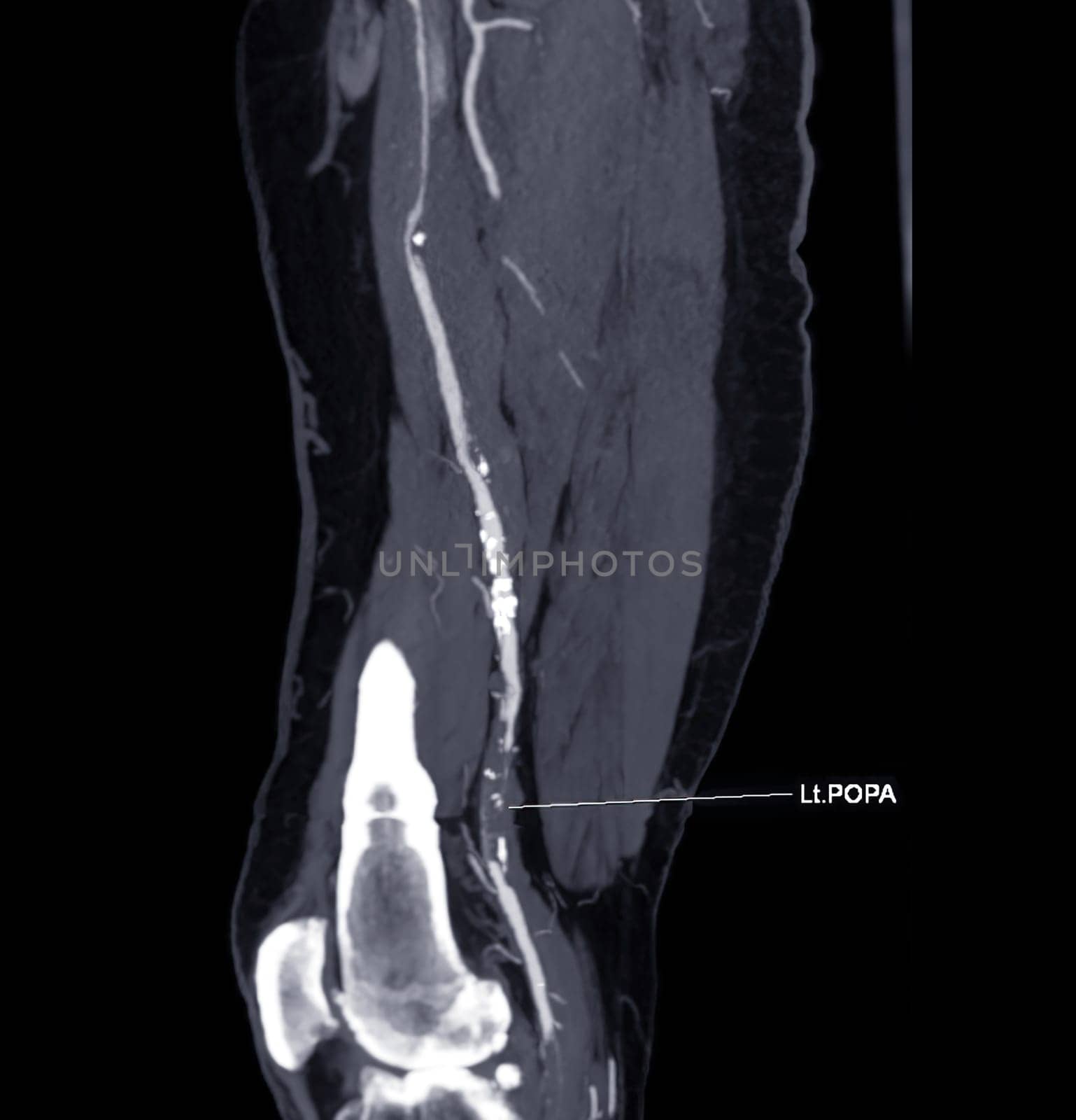 CTA femoral artery run off MPR curve showing Left femoral artery for diagnostic Acute or Chronic Peripheral Arterial Disease.