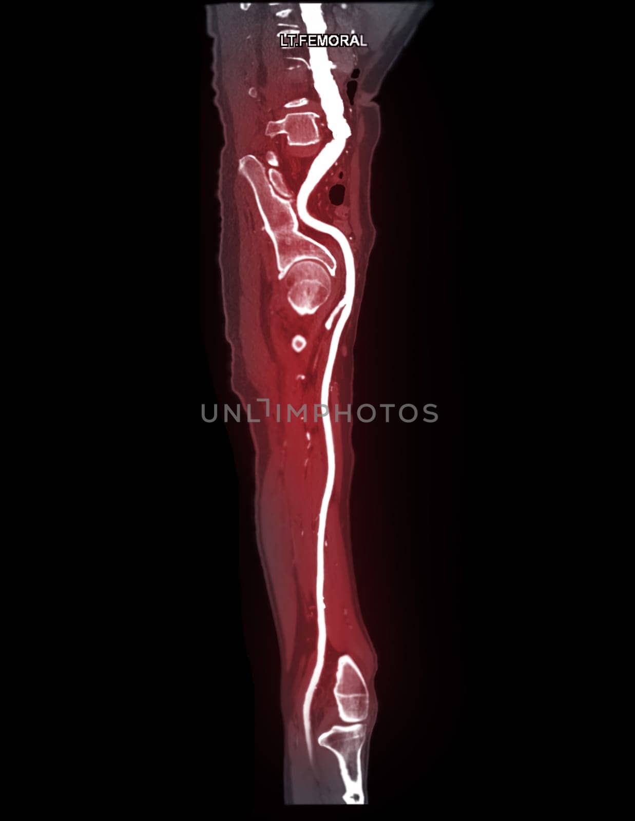 CTA femoral artery run off MPR curve showing Left femoral artery for diagnostic Acute or Chronic Peripheral Arterial Disease.