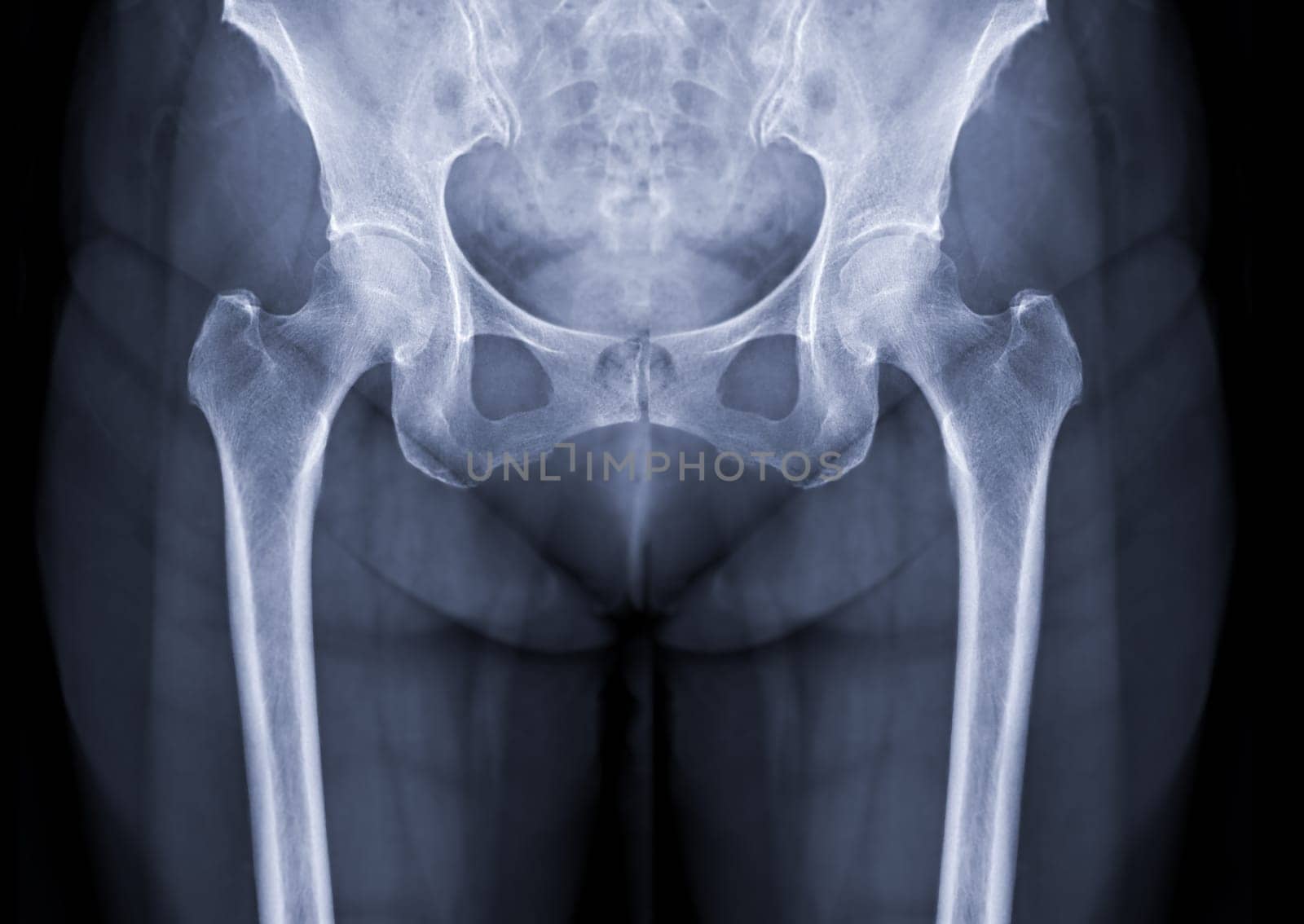 X-ray image of Both hip joint.