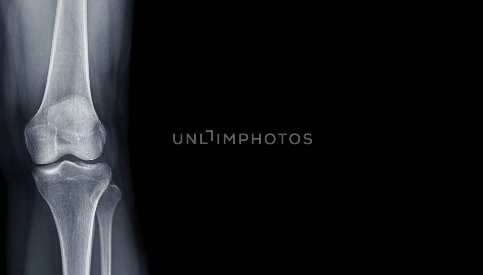 Film x-ray of Left knee joint AP view for medical background.