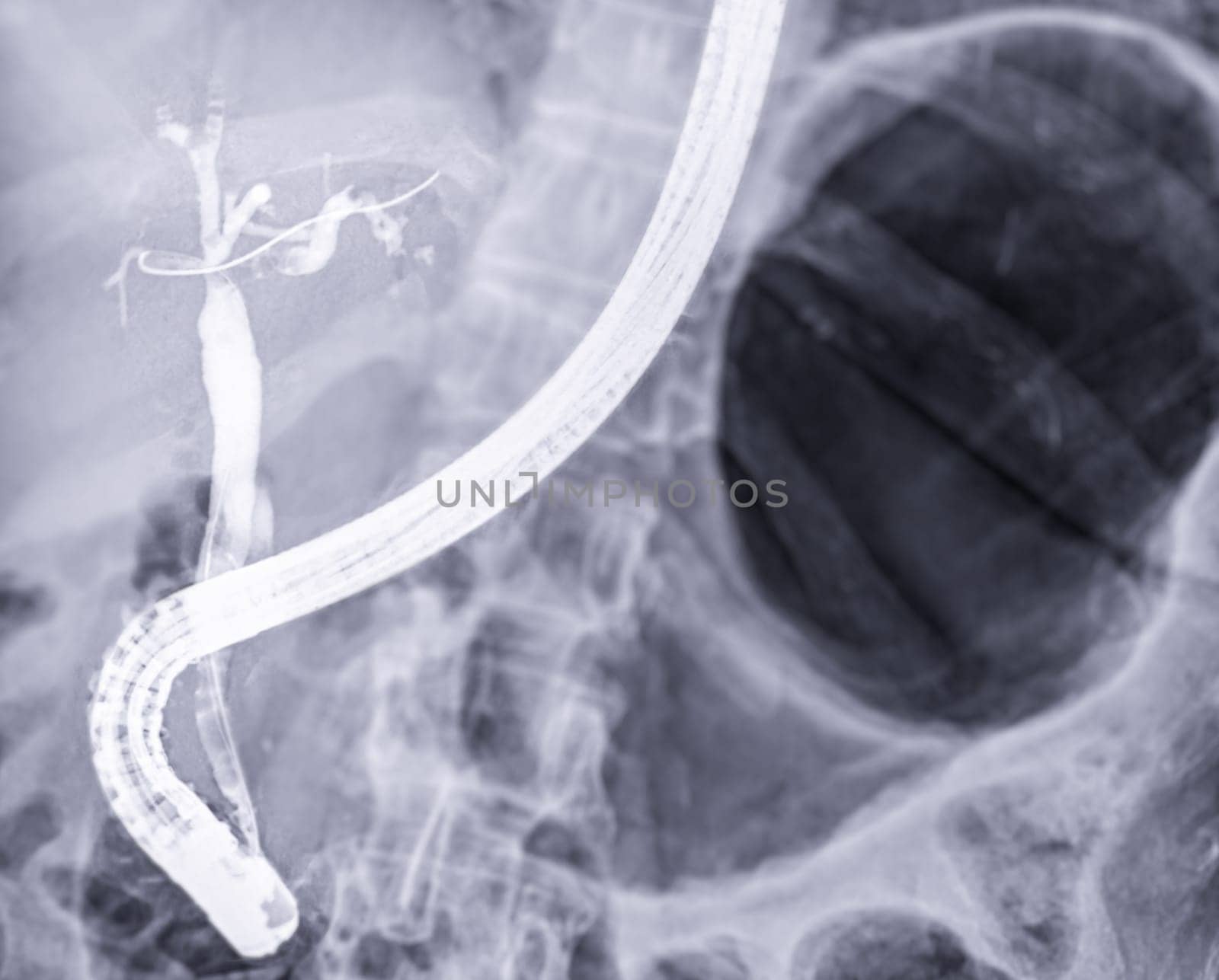 X-ray image of endoscopic after Doctor doing ERCP and laparoscopic cholecystectomy inside modern operating room. by samunella