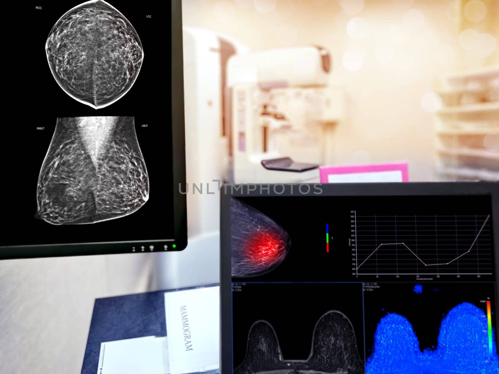 Mammography machine with monitor for breast screening device on mammogram room background.