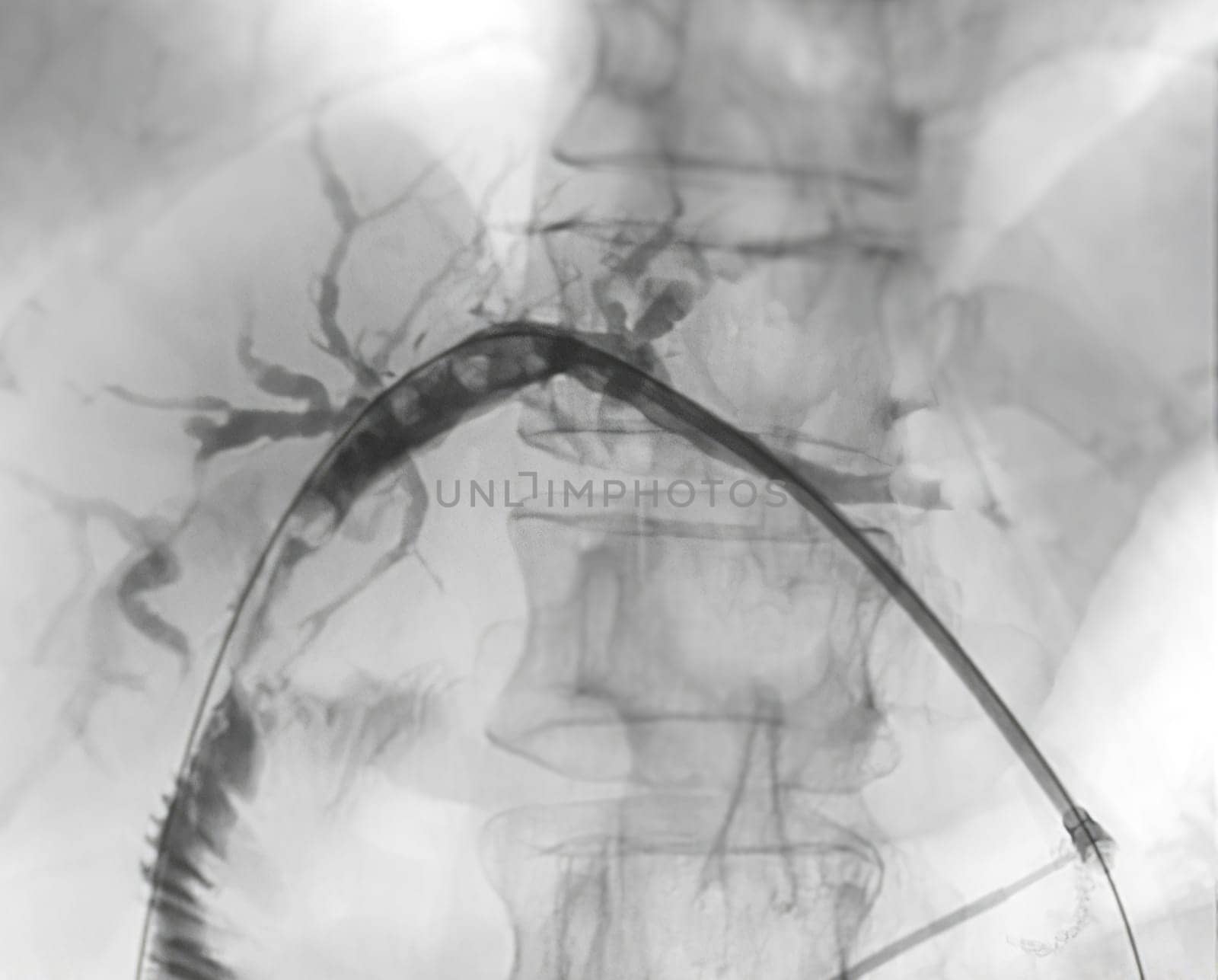 X-ray image of portal vein after Doctor doing ERCP and laparoscopic cholecystectomy inside modern operating room. by samunella