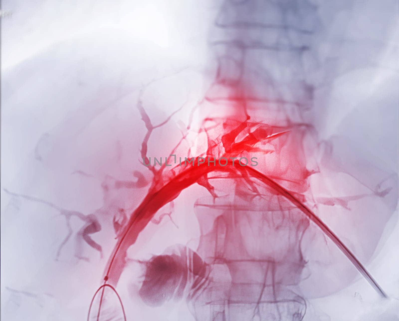 X-ray image of portal vein after Doctor doing ERCP and laparoscopic cholecystectomy inside modern operating room. by samunella