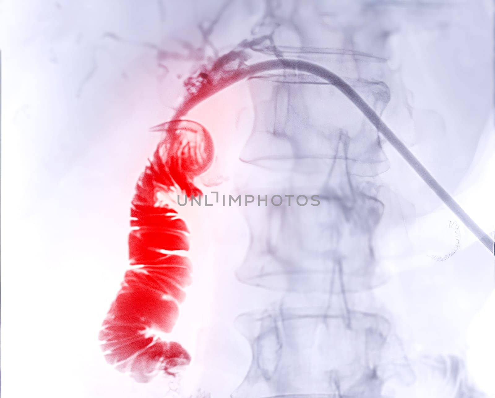 X-ray image of portal vein after Doctor doing ERCP and laparoscopic cholecystectomy inside modern operating room.