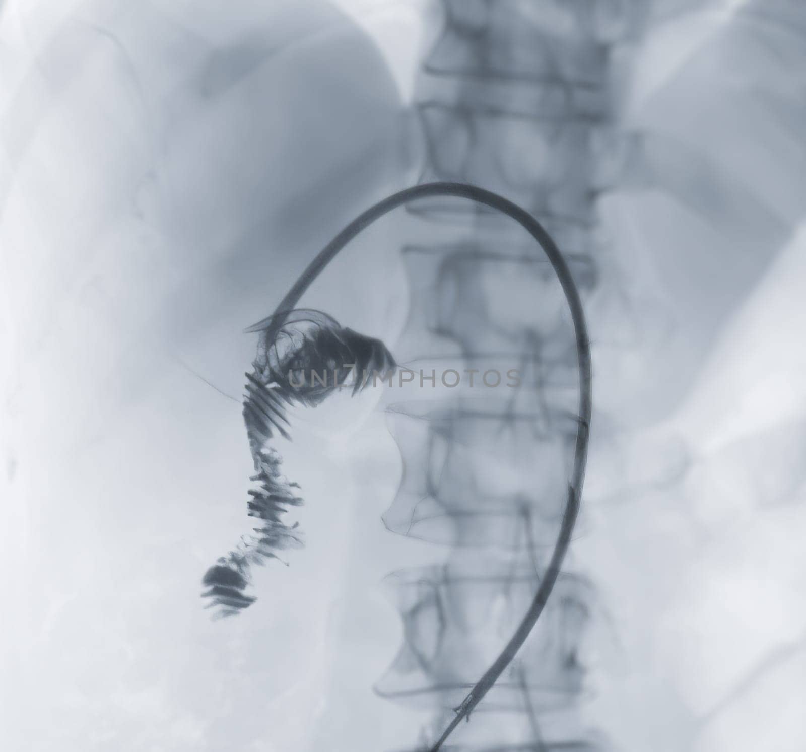 X-ray image of portal vein after Doctor doing ERCP and laparoscopic cholecystectomy inside modern operating room. by samunella