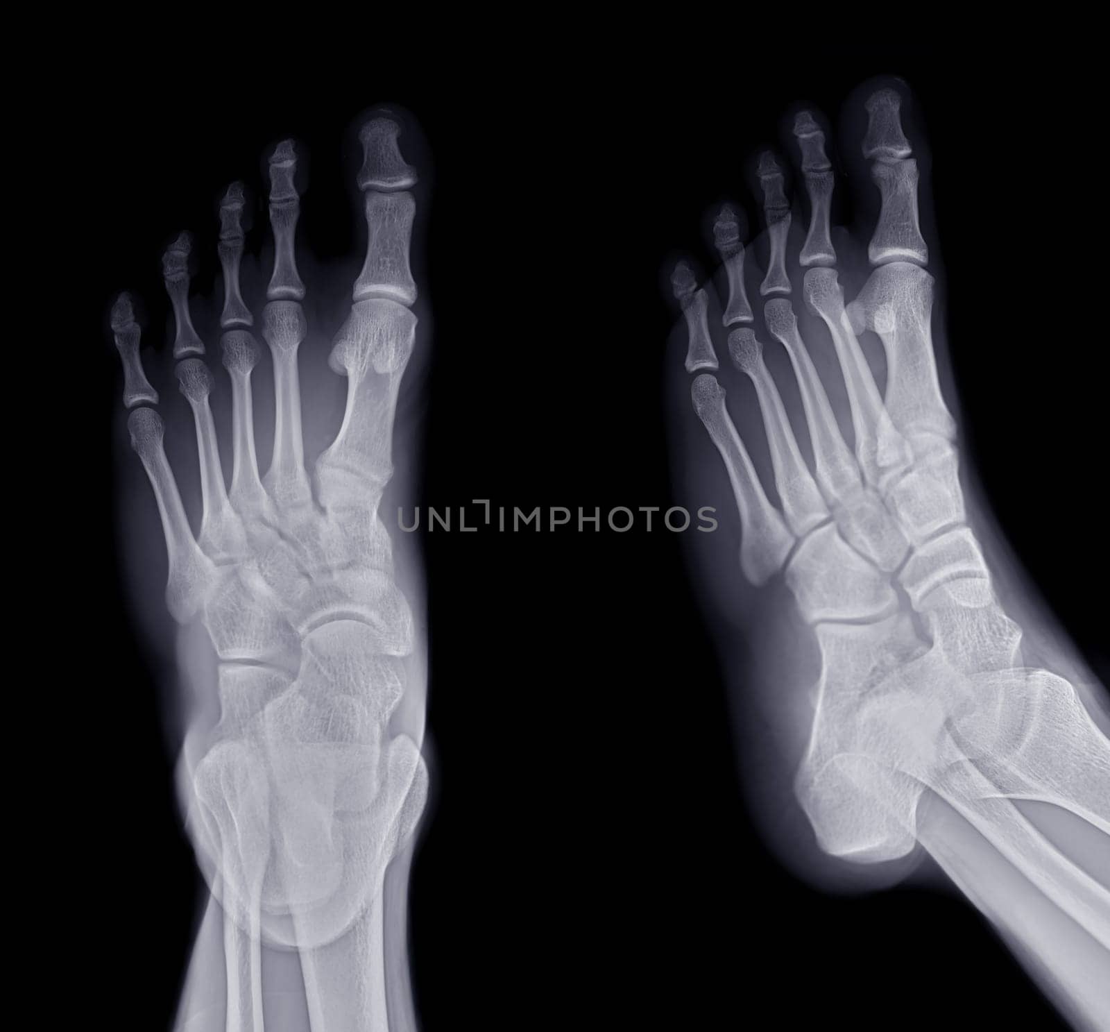 Foot x-ray image AP and Oblique view isolated on black background.