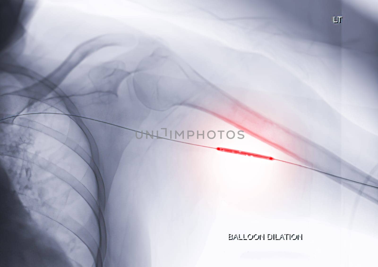 Angioplasty, balloon angioplasty and percutaneous transluminal angioplasty (PTA) on Left arm. by samunella