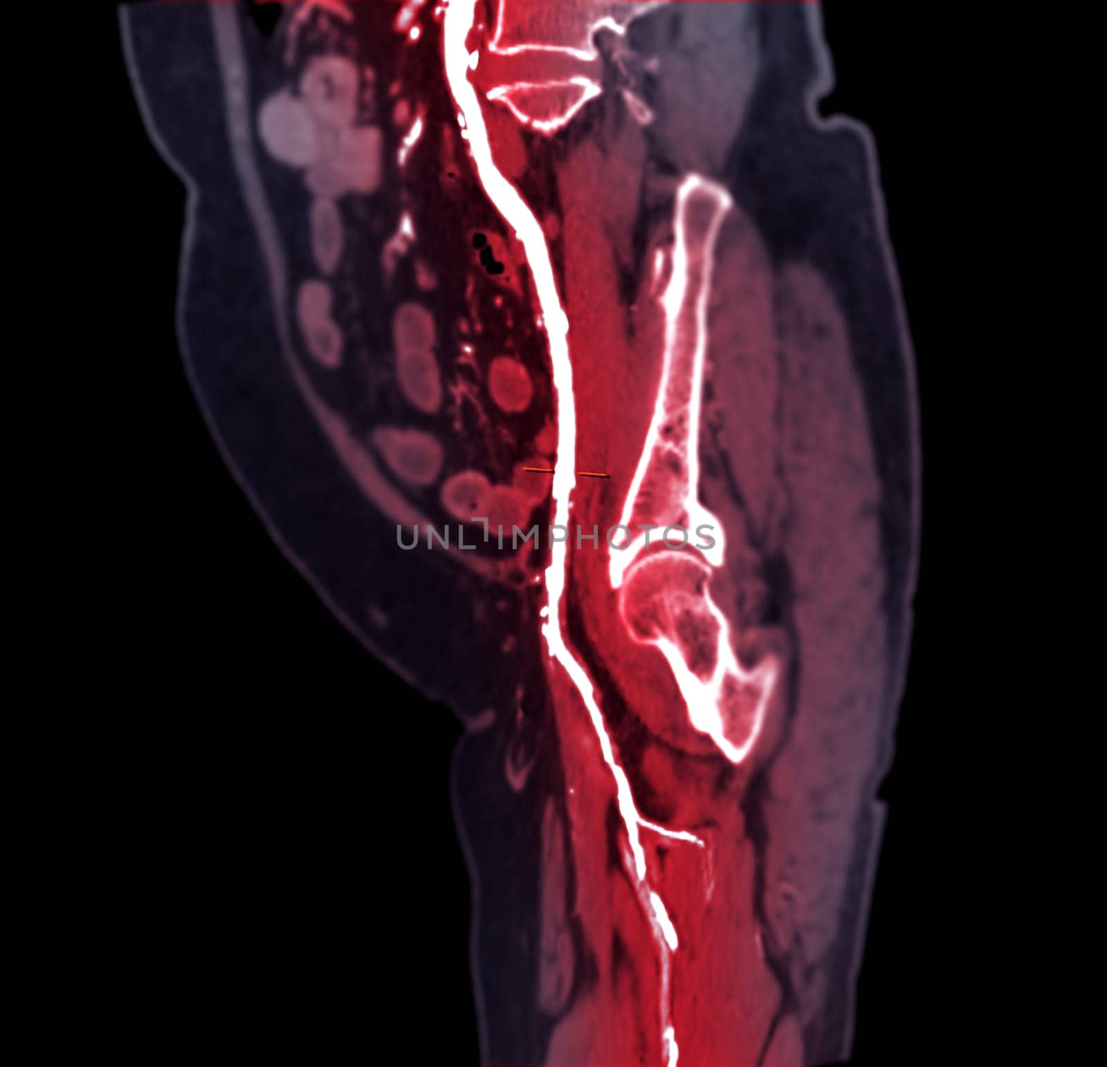 CTA femoral artery run off MPR curve showing Left femoral artery for diagnostic Acute or Chronic Peripheral Arterial Disease.