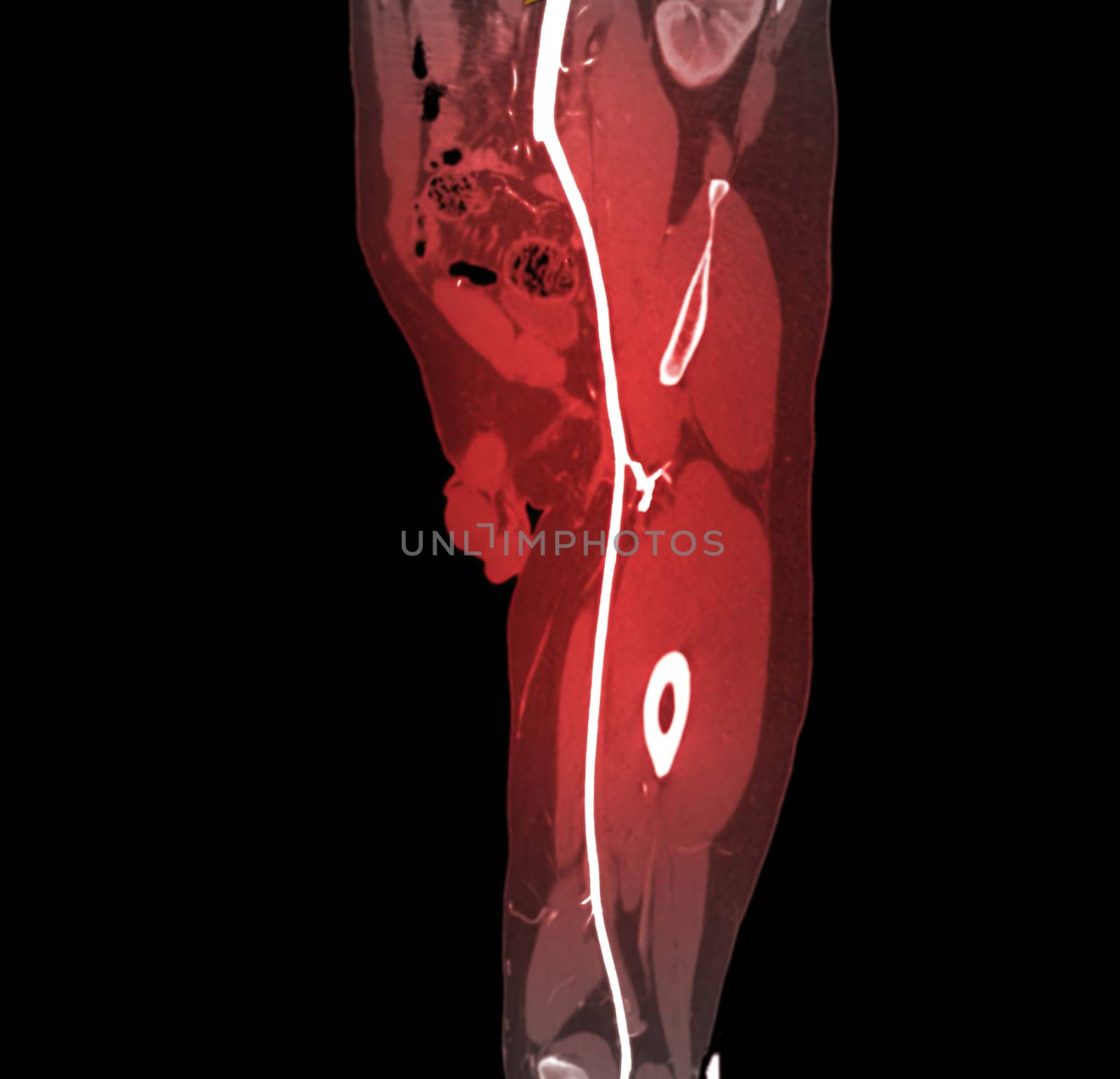 CTA femoral artery run off MPR curve . by samunella