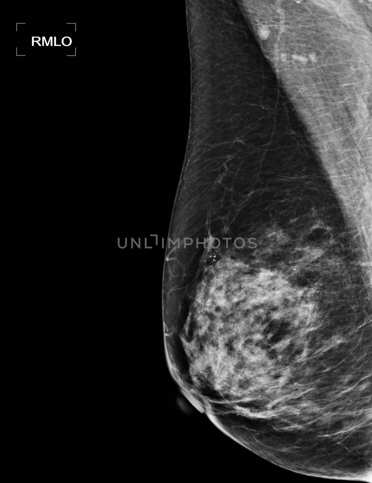 X-ray Digital Mammogram or mammography of both side breast showing benign tumor BI-RADS 2 should be checked once a year.
