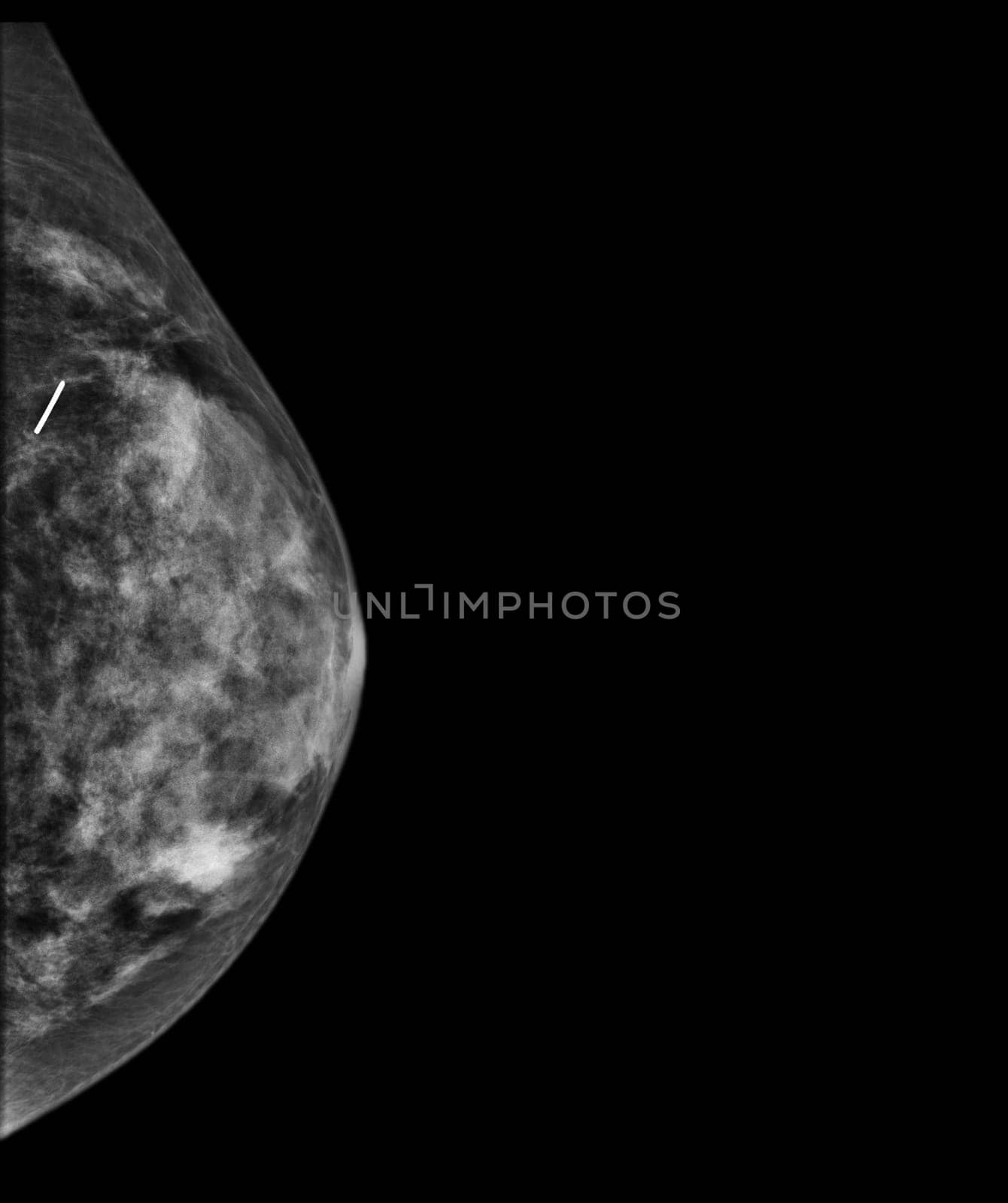 X-ray Digital Mammogram or mammography of both side breast showing benign tumor BI-RADS 2 should be checked once a year.