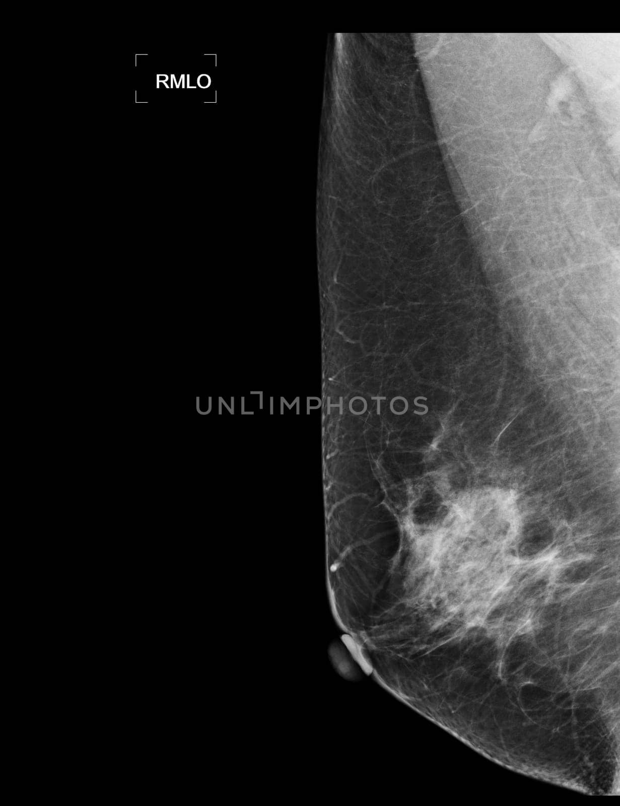 X-ray Digital Mammogram or mammography of both side breast showing benign tumor BI-RADS 2 should be checked once a year.