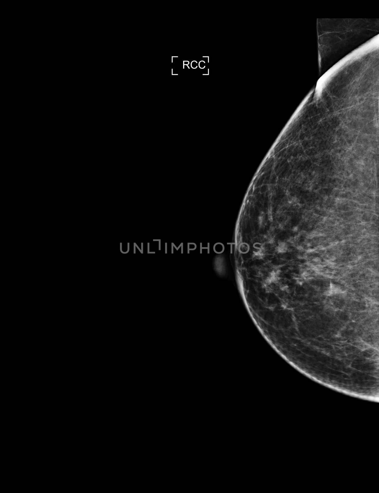 X-ray Digital Mammogram or mammography of both side breast showing Normal breast BI-RADS 1 should be checked once a year.