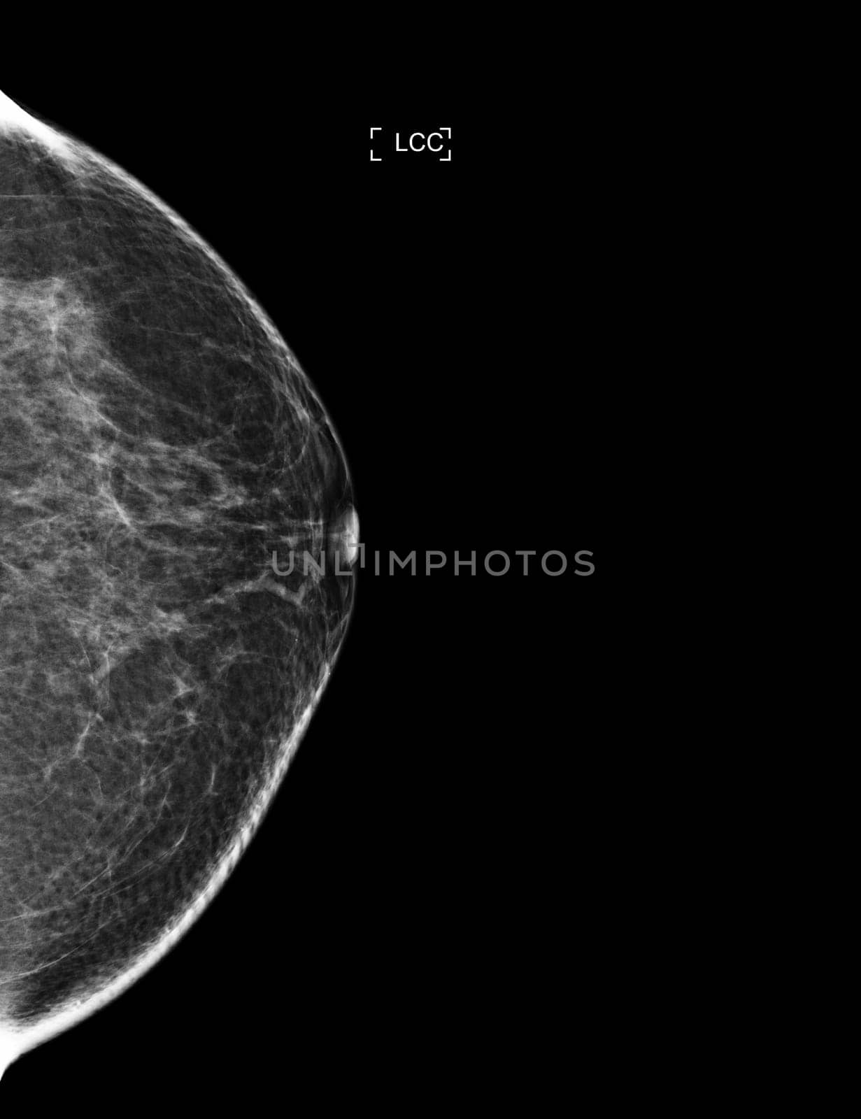 X-ray Digital Mammogram or mammography of both side breast showing benign tumor BI-RADS 2 should be checked once a year.