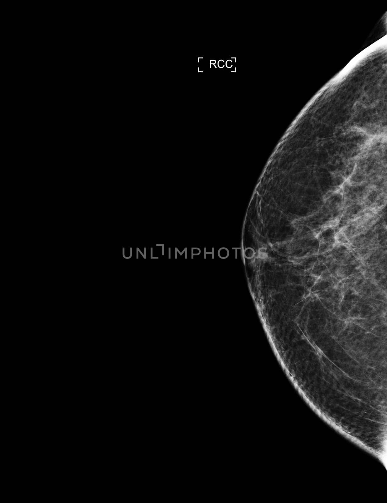 X-ray Digital Mammogram or mammography of both side breast showing benign tumor BI-RADS 2 should be checked once a year.