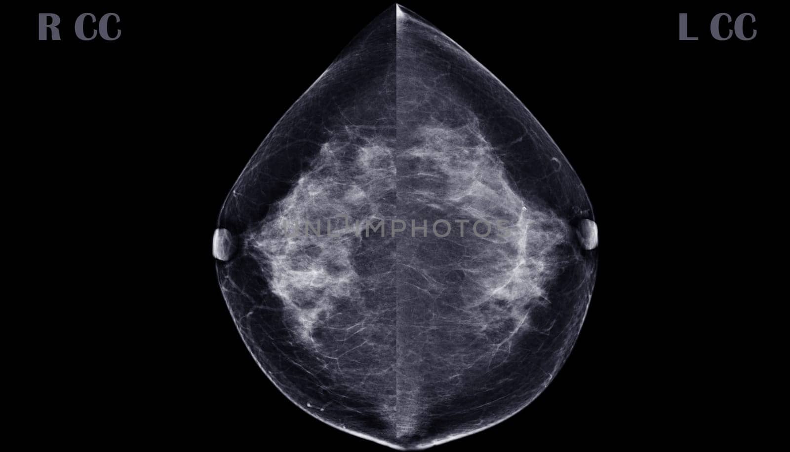 X-ray Digital Mammogram or mammography of both side breast CC view showing benign tumor BI-RADS 2 should be checked once a year.