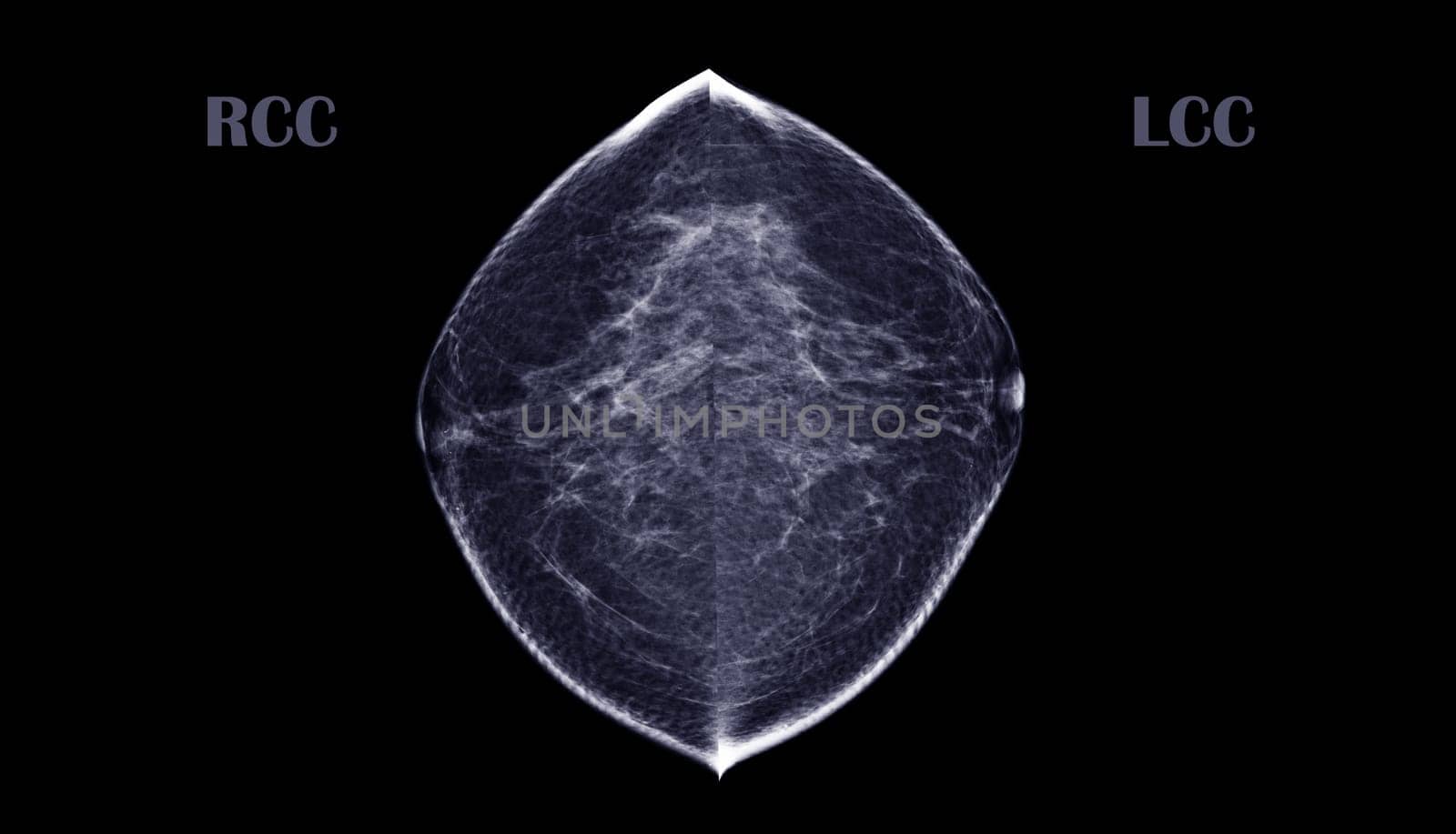 X-ray Digital Mammogram or mammography of both side breast CC View showing benign tumor BI-RADS 2 should be checked once a year. by samunella