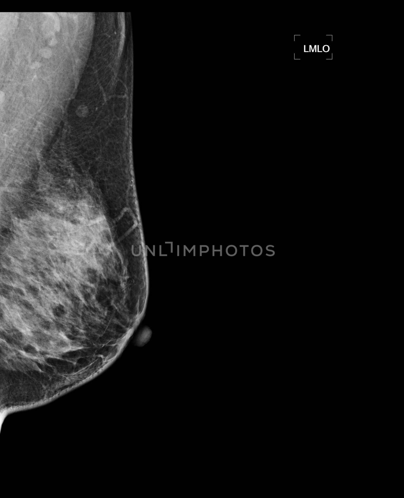 X-ray Digital Mammogram or mammography of both side breast showing benign tumor BI-RADS 3 should be checked once a year.