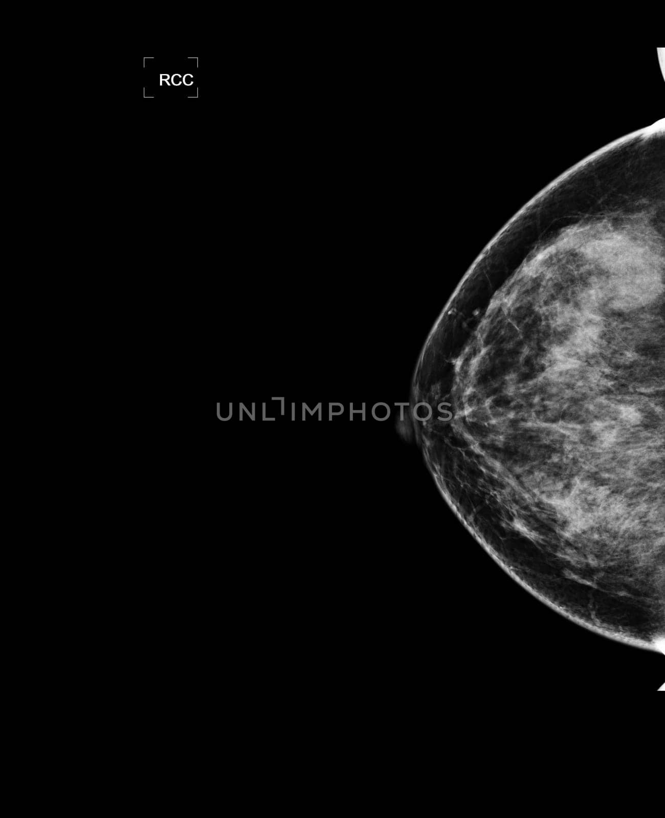 X-ray Digital Mammogram or mammography of both side breast showing benign tumor BI-RADS 3 should be checked once a year.