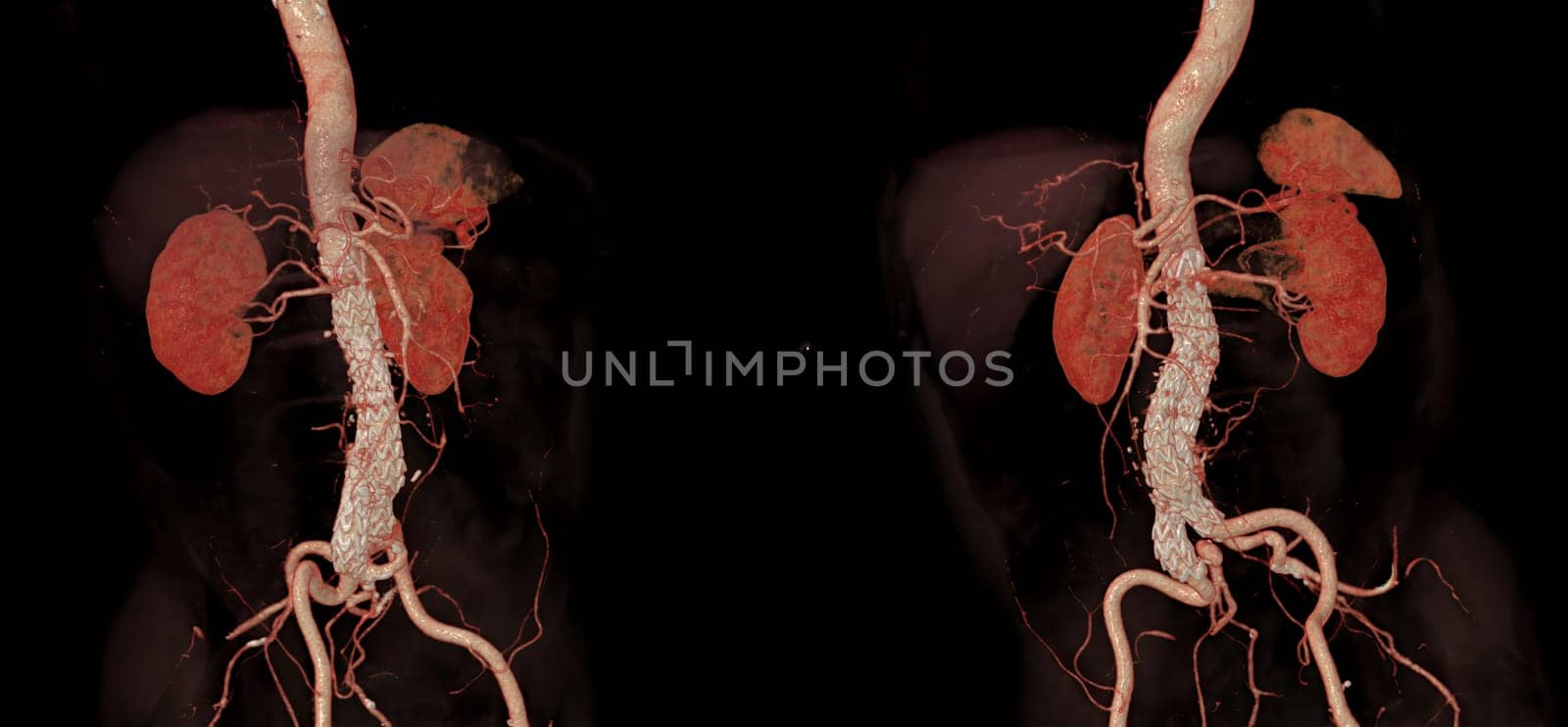 CTA whole aorta with Abdominal aorta stent graft compare 3D rendering image in case abdominal aortic aneurysms.