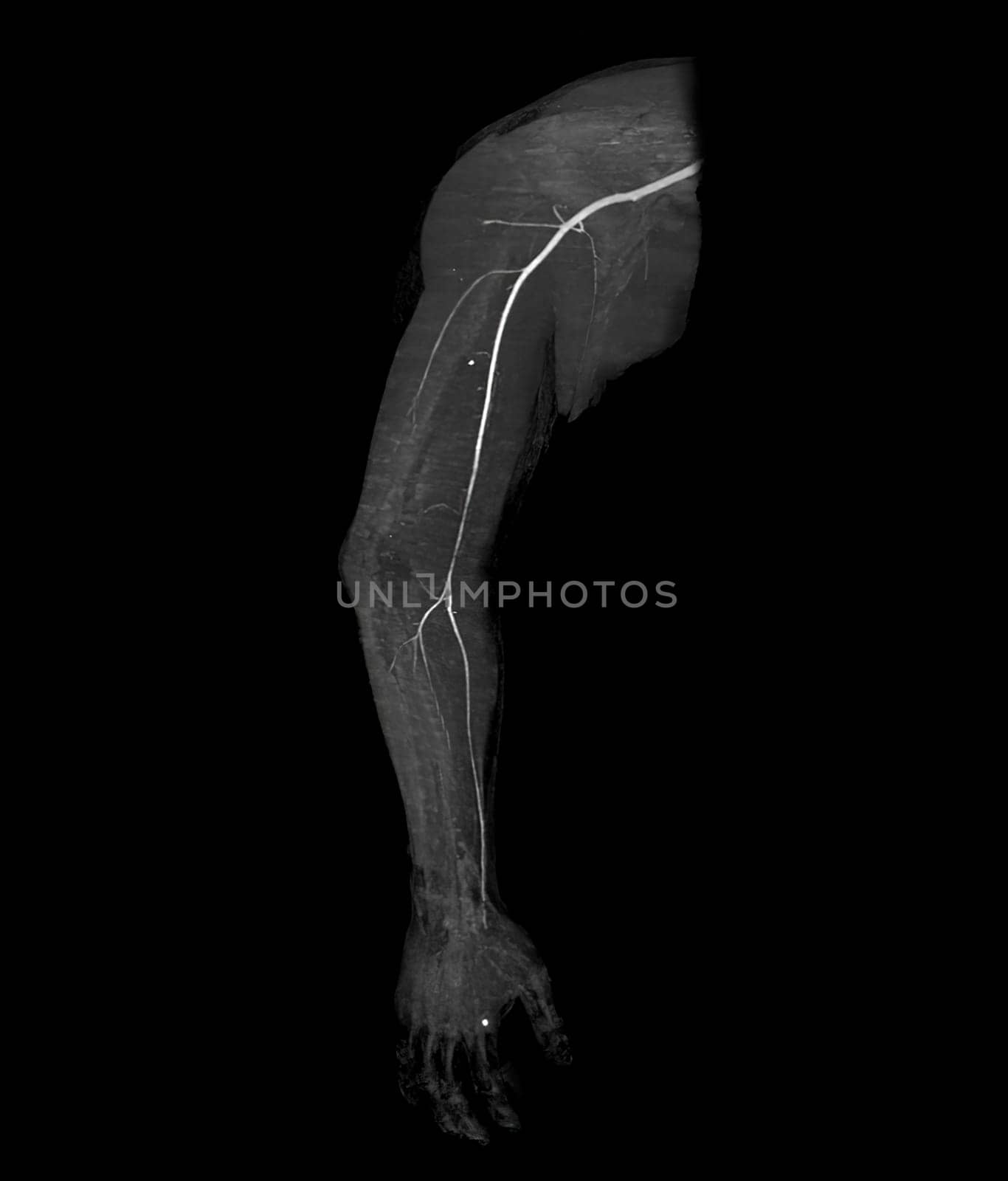 CTA brachial artery or CT scan of upper extremity 3D rendering image .