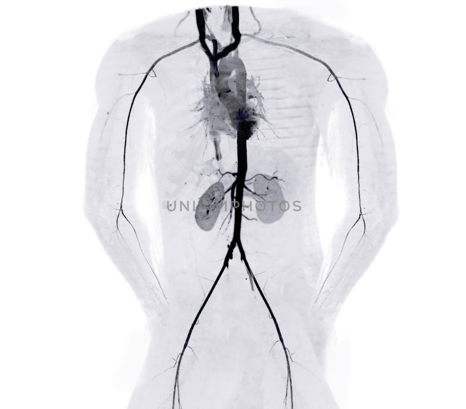 CTA whole aorta and brachial artery 3D rendering image in case patient tramatic. by samunella