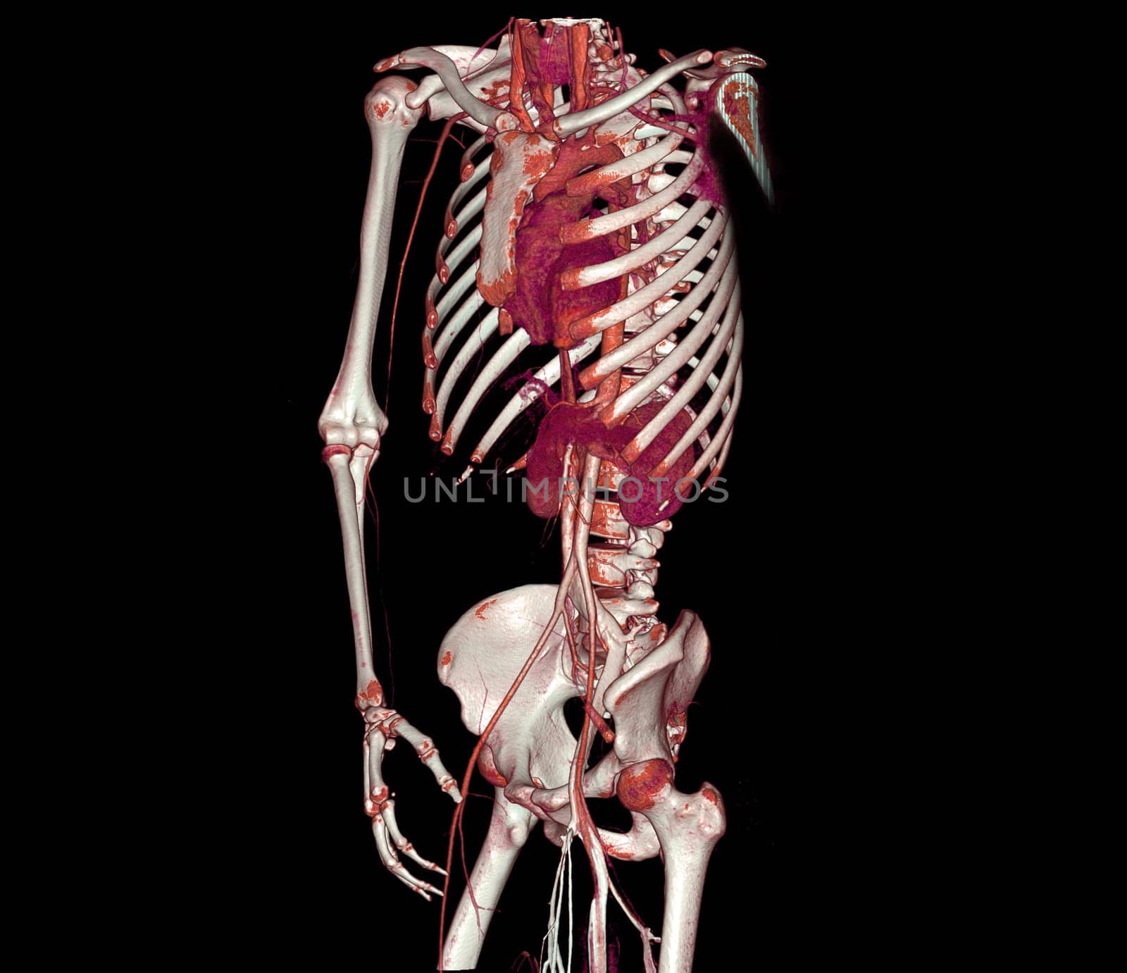 CTA whole aorta and brachial artery 3D rendering image in case patient tramatic.