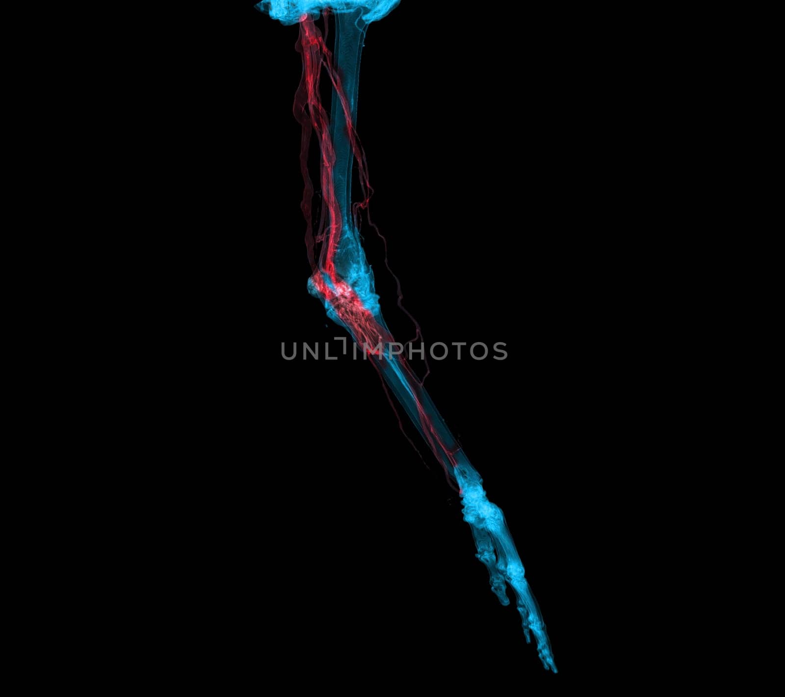 Brachial Arteries of the arm with Upper extremity Bone 3D rendering from CT Scanner.